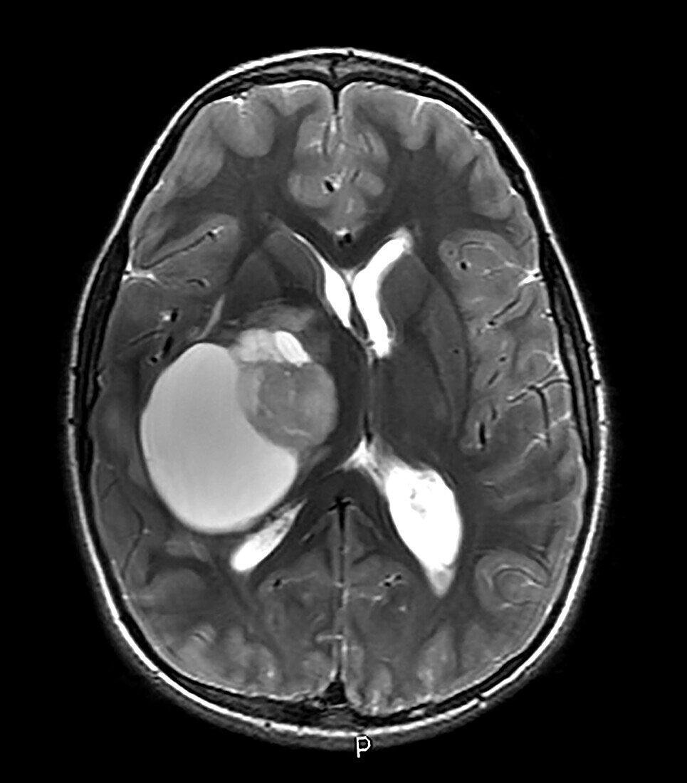 MRI Pilocytic Astrocytoma