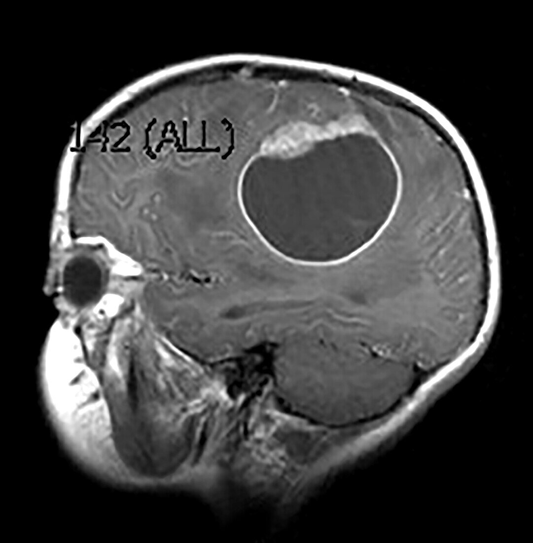 Primitive Neuroectodermal Tumour (PNET) MRI