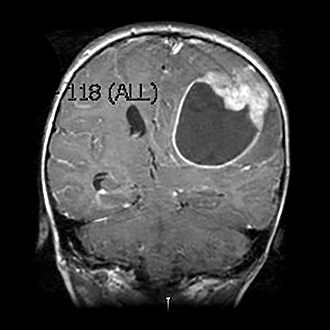 Primitive Neuroectodermal Tumour (PNET) MRI