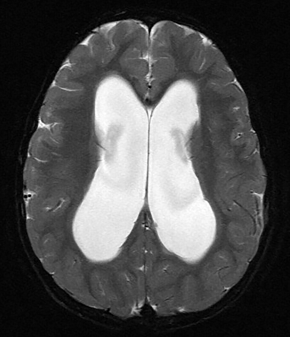 MRI of Pontine Glioma in Child