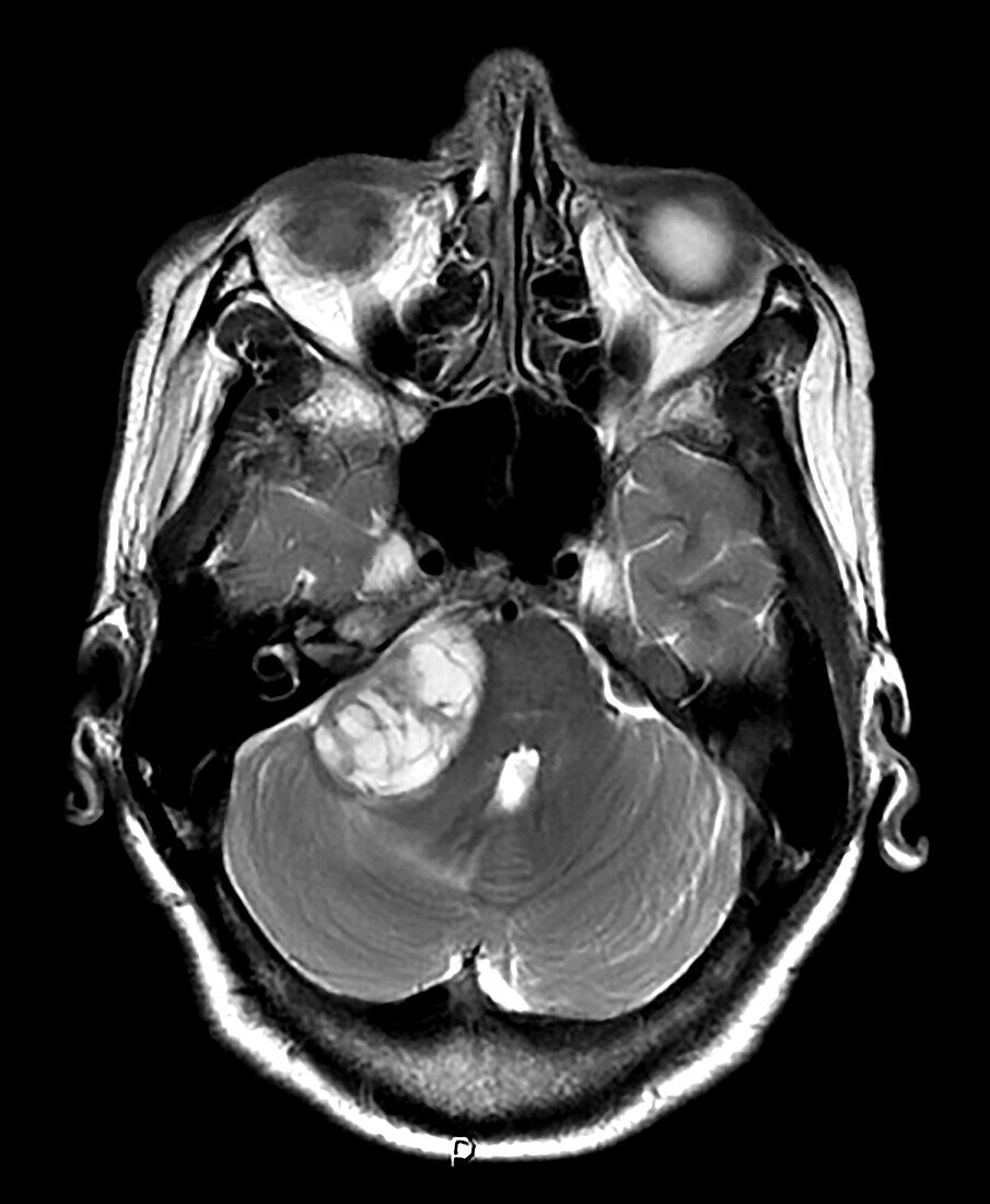 Large Vestibular Schwannoma MRI