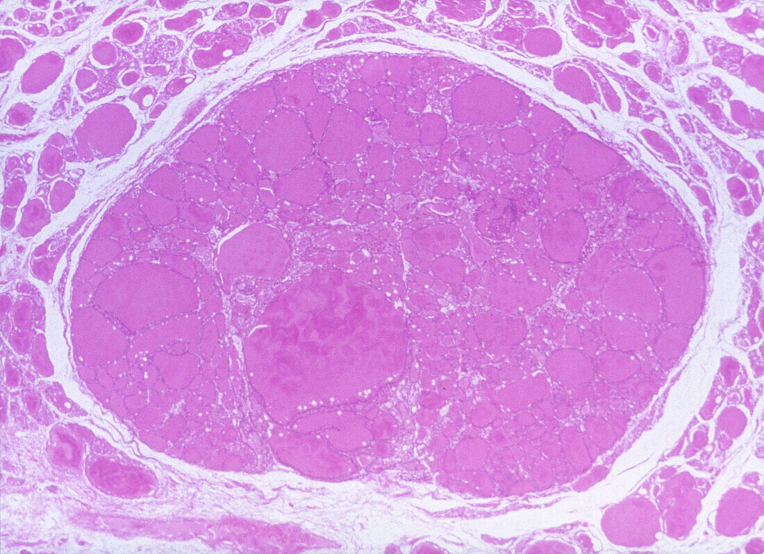 Benign Neoplasm of Thyroid Gland, LM