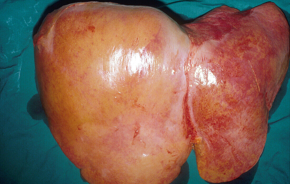 Liver with Cirrhosis