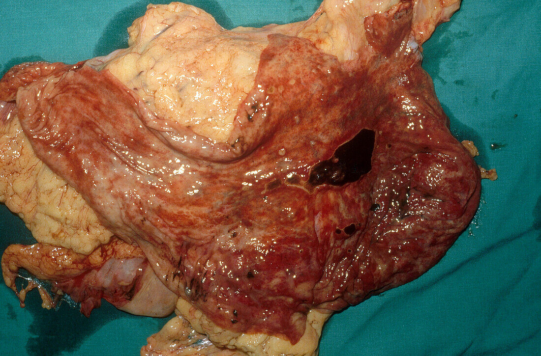 Acute Gastric Ulcer