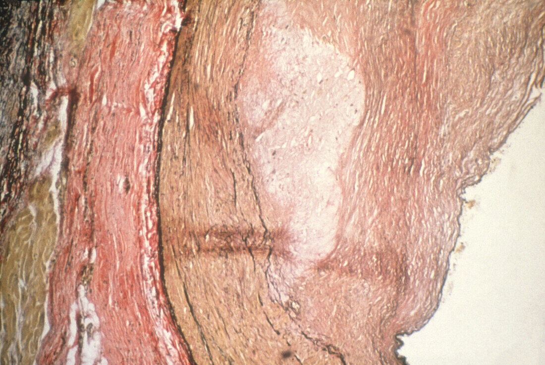 Diseased Coronary Artery, LM