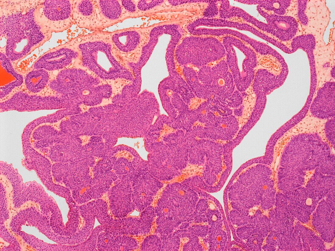 Papilloma of the bladder, LM