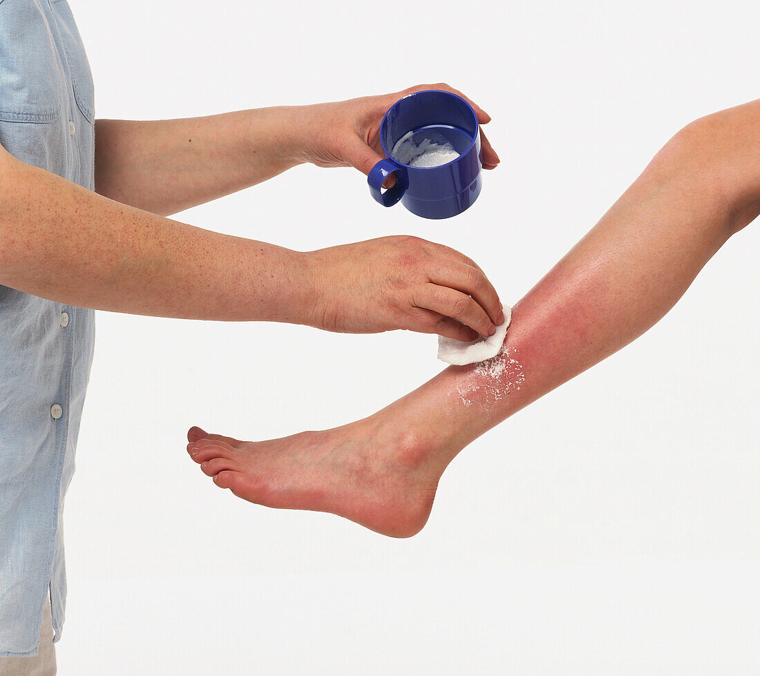 Applying paste from mug to jellyfish sting on child's Leg