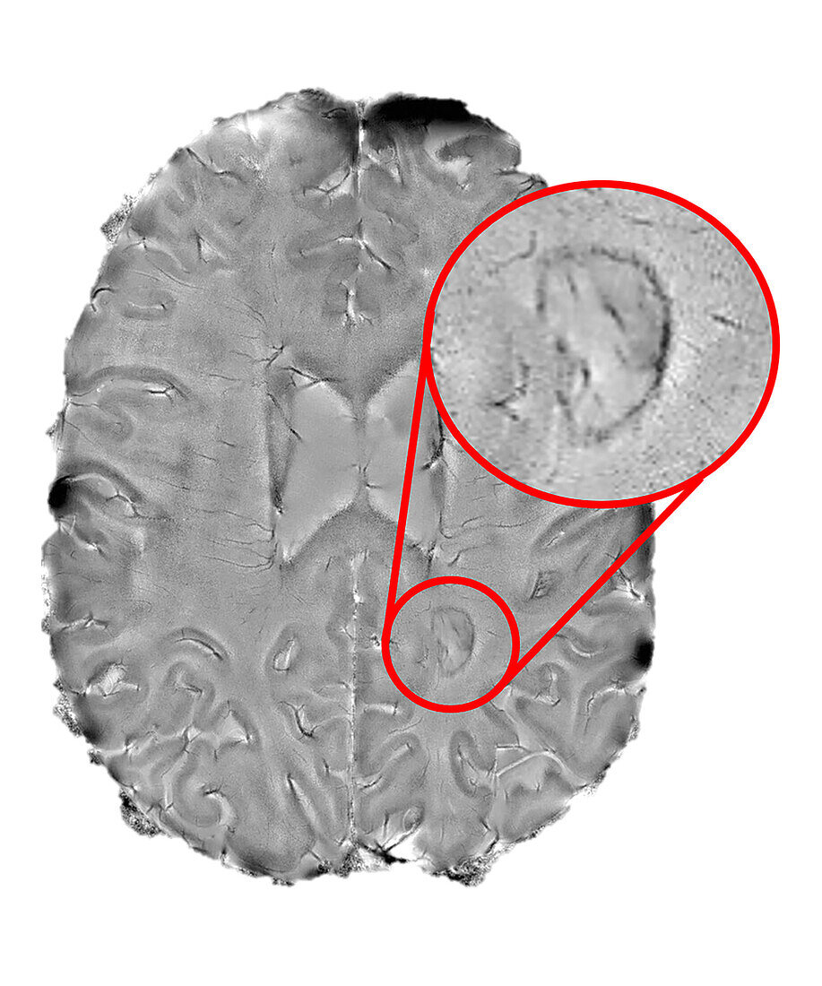 Chronic active lesions in the brain, MRI scan