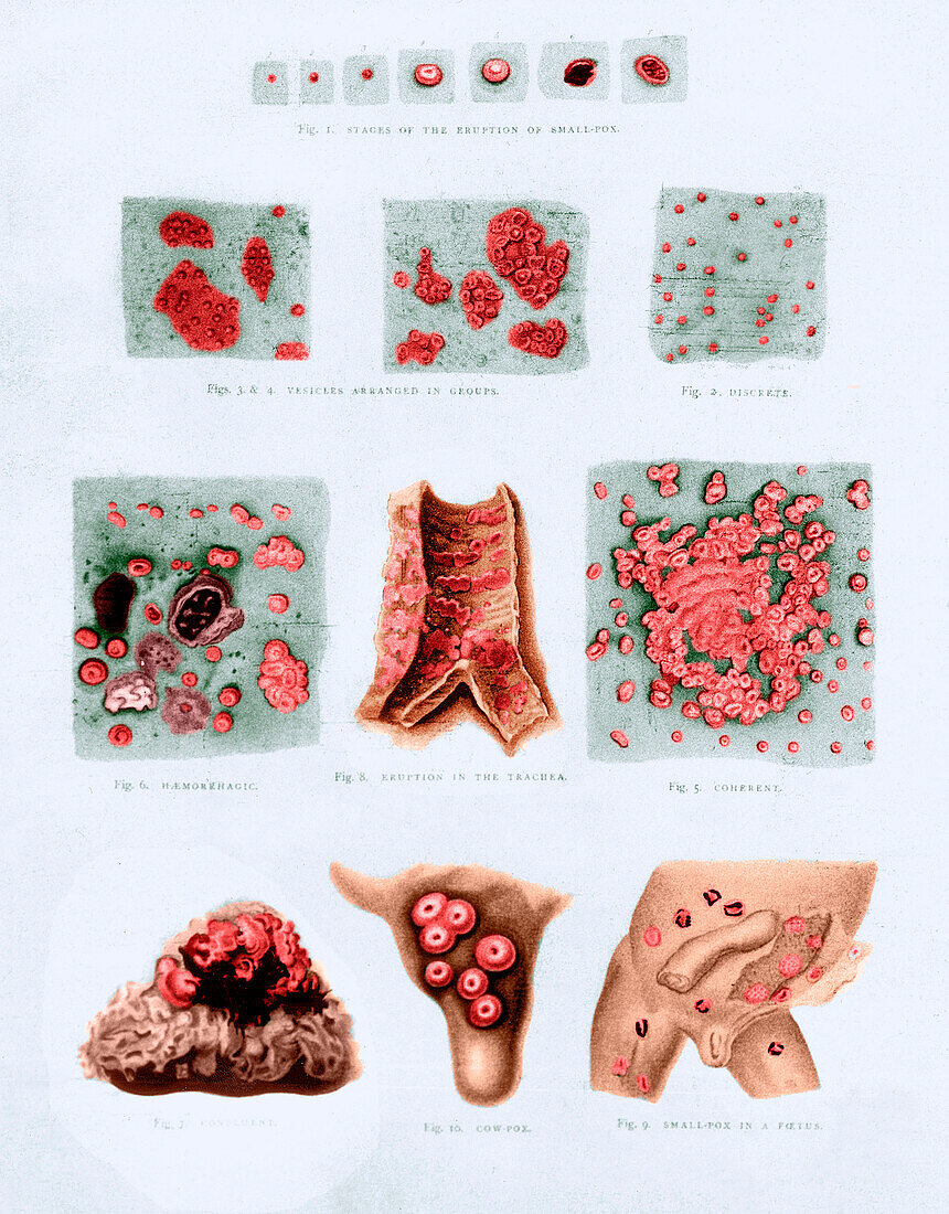 Stages and types of smallpox