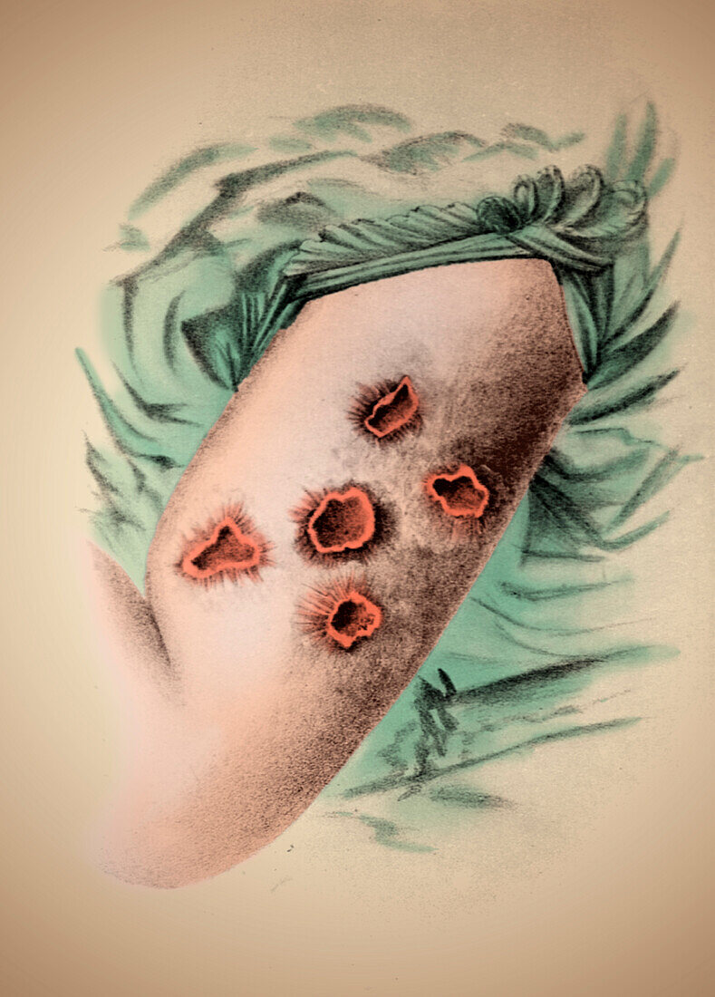 Smallpox pustules, 1898