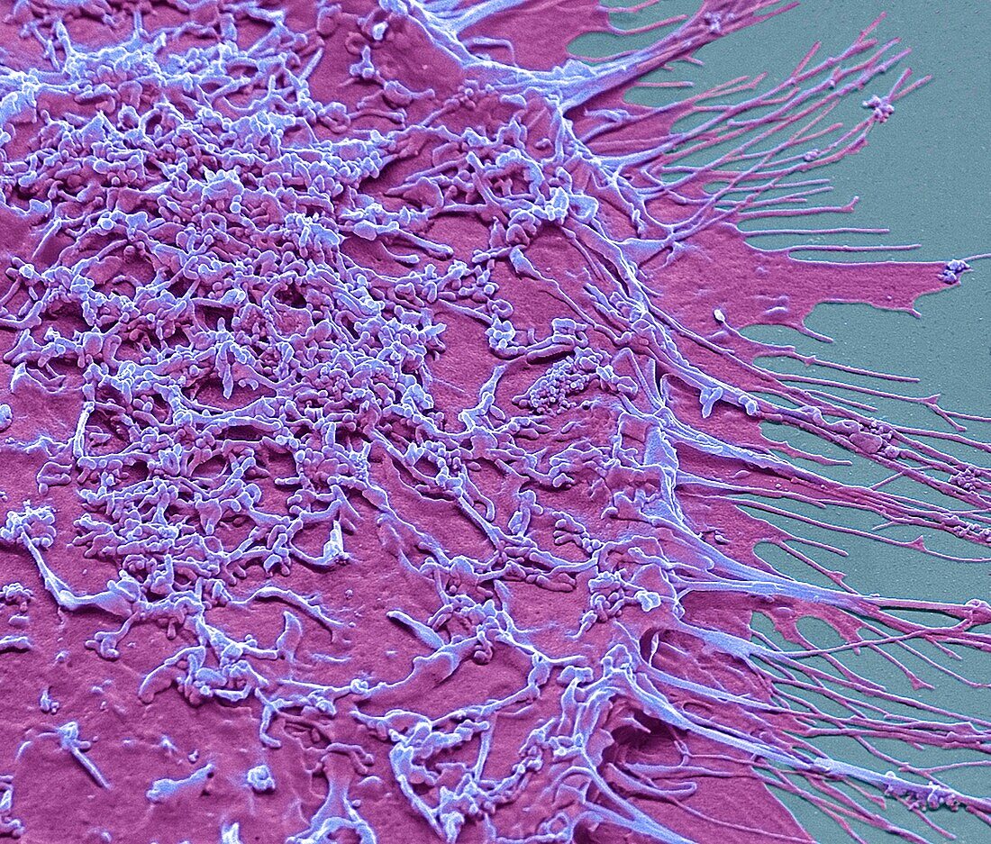 Vaginal cancer cells, SEM