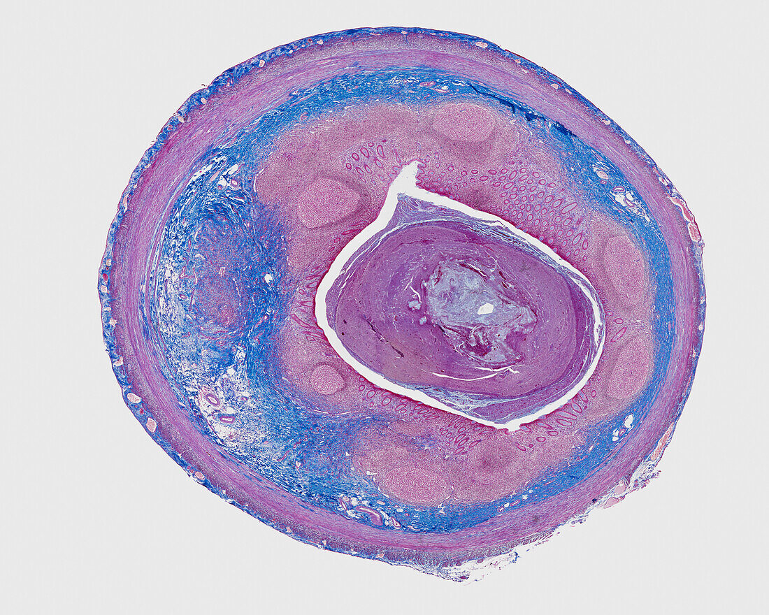 Appendix, light micrograph