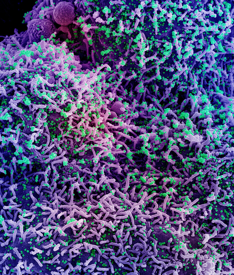 Cell infected by SARS-Cov-2 virus particles, SEM