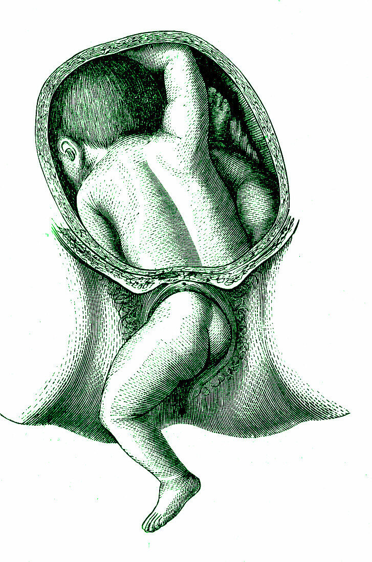 Foetal childbirth, 19th century illustration