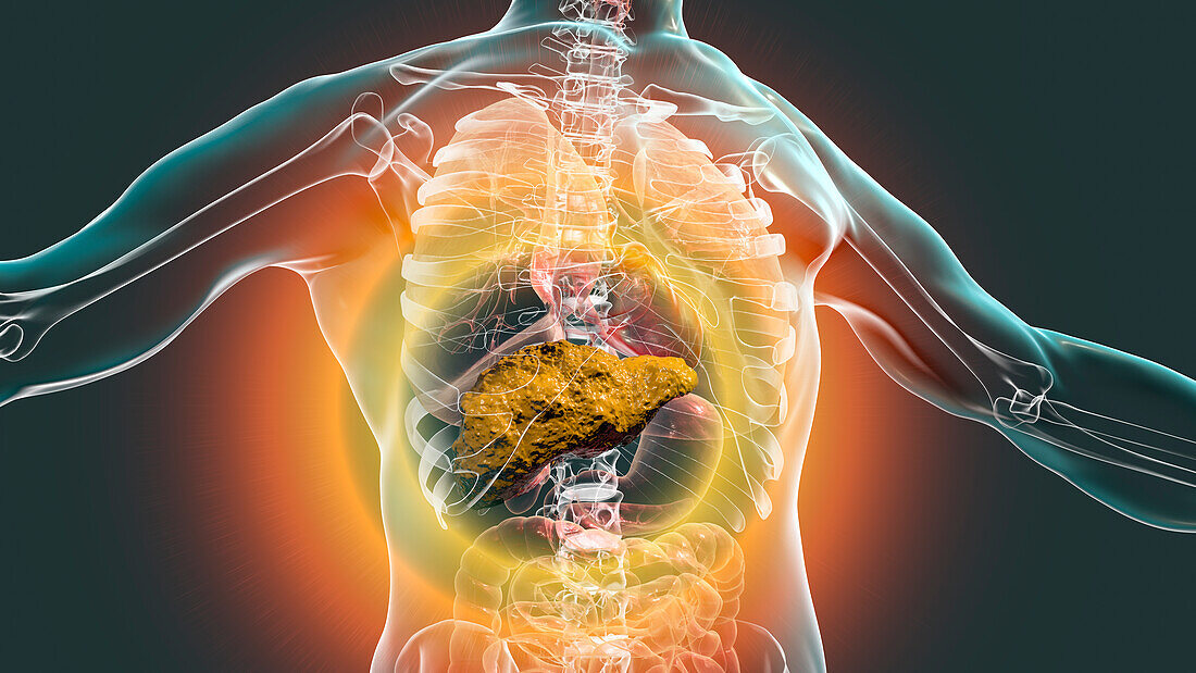 Liver Cirrhosis, illustration