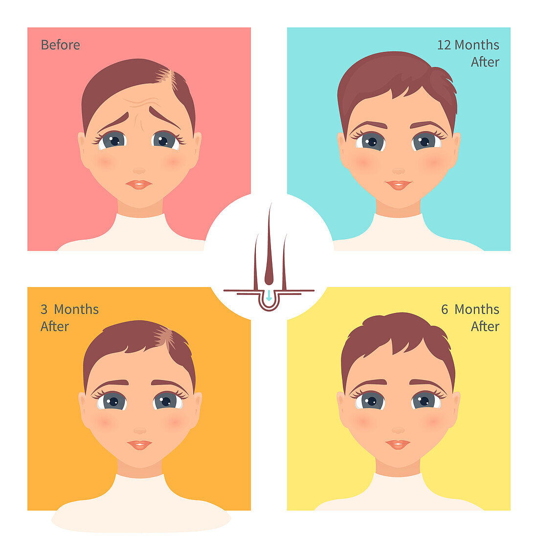 Hair transplantation surgery result in women, illustration