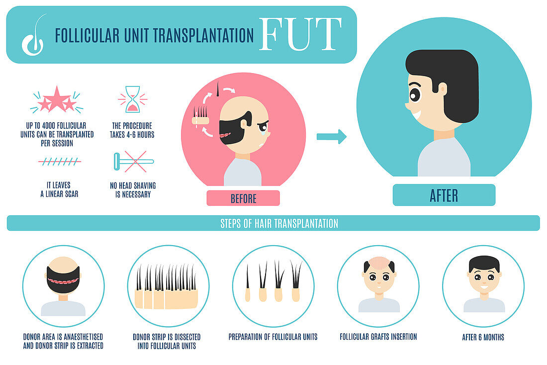 FUT hair transplantation in men, illustration