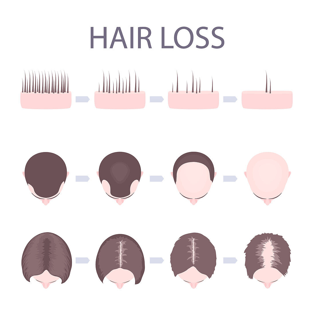 Male and female hair loss patterns, conceptual illustration
