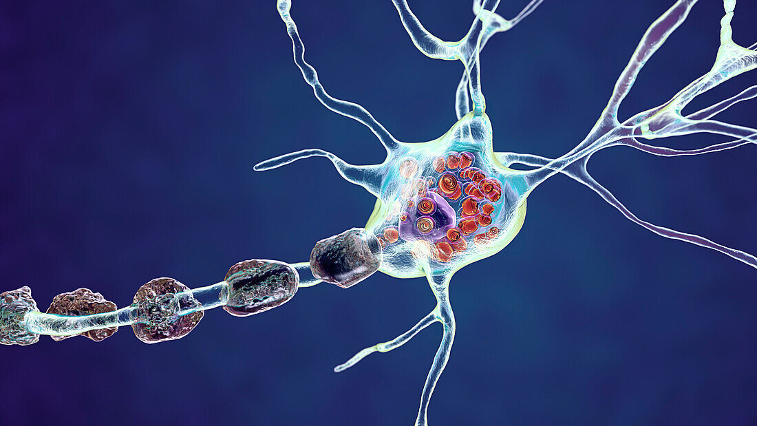 Neurons in Tay-Sachs disease, illustration