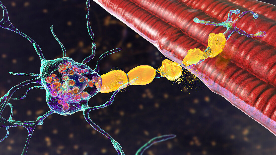 Neurons in Tay-Sachs disease, illustration