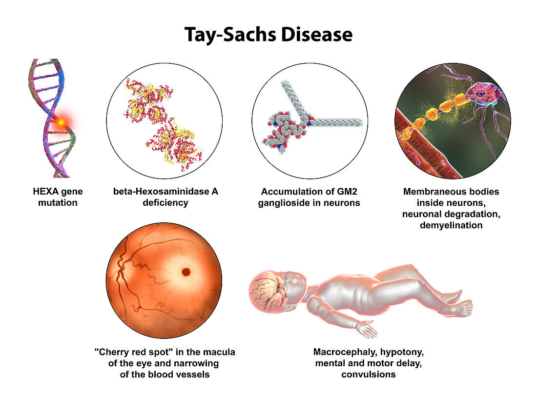 Tay-Sachs disease, illustration