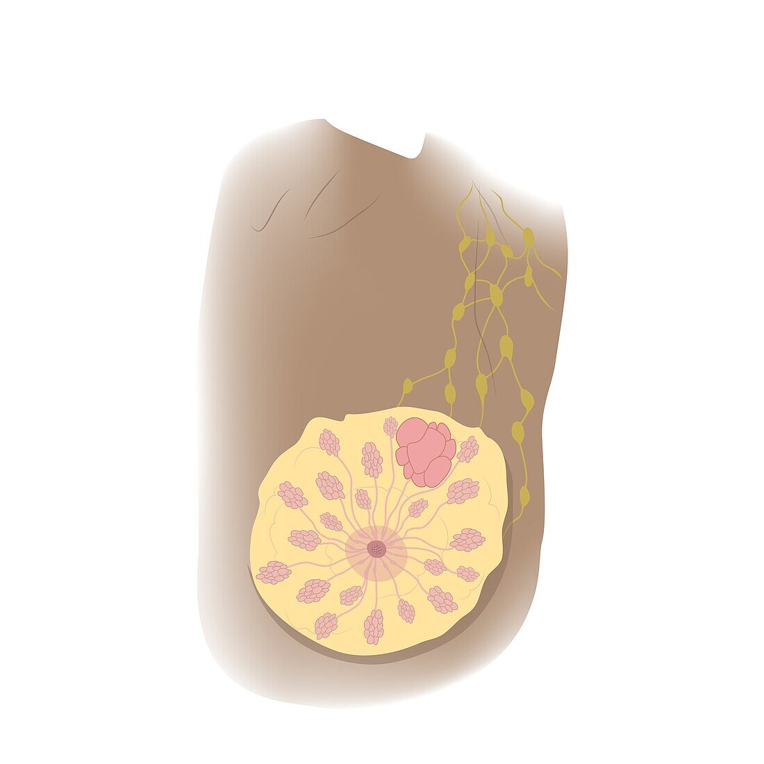 Enlarged lobes in female breast, illustration