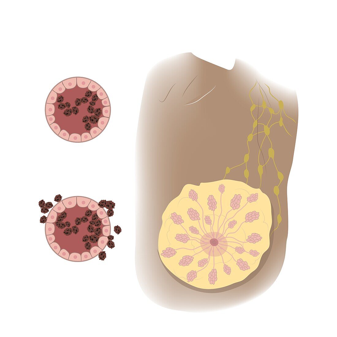 Ductal cancer in female breast, illustration