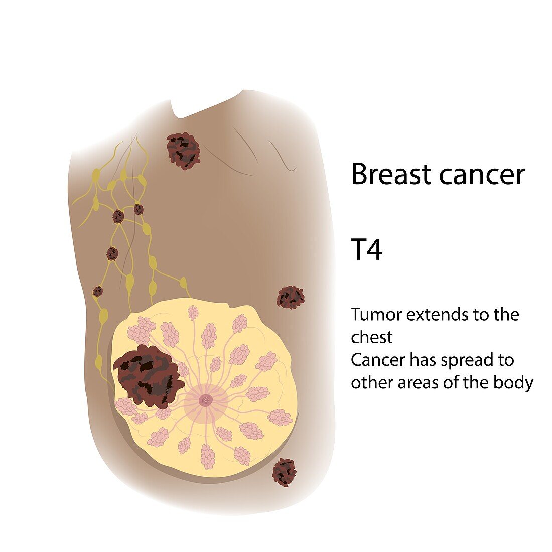 Female breast cancer , illustration