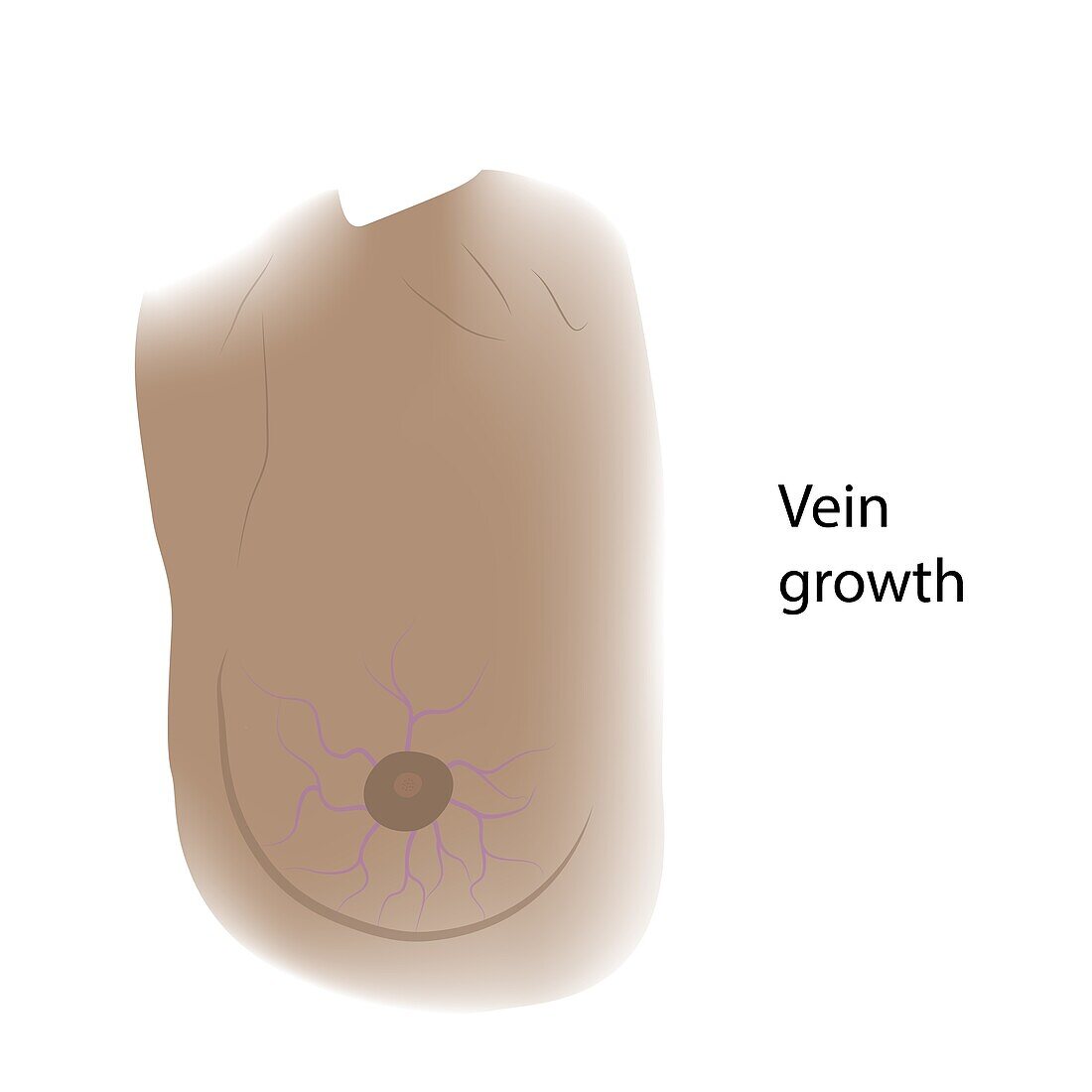 Vein growth in female breast, illustration