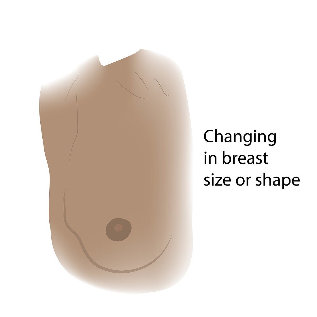 Change in female breast shape, illustration