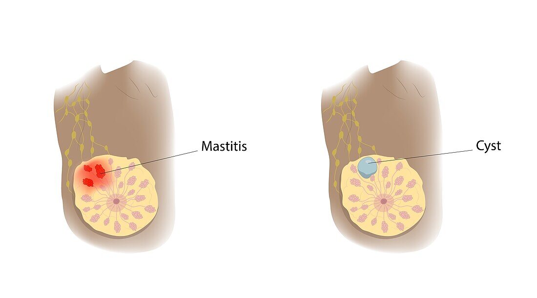 Mastitis and cyst comparison, illustration