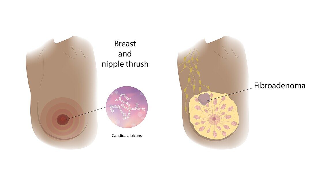 Fibroadenoma and thrush comparison, illustration