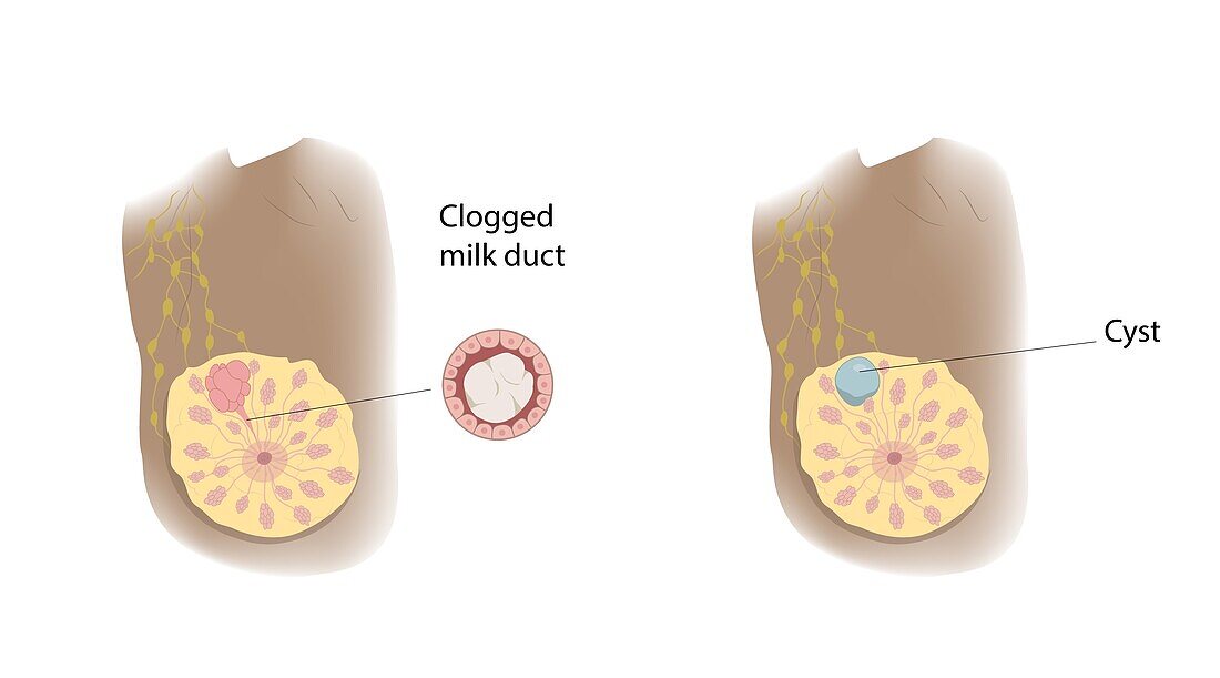 Clogged milk duct and cyst comparison, illustration