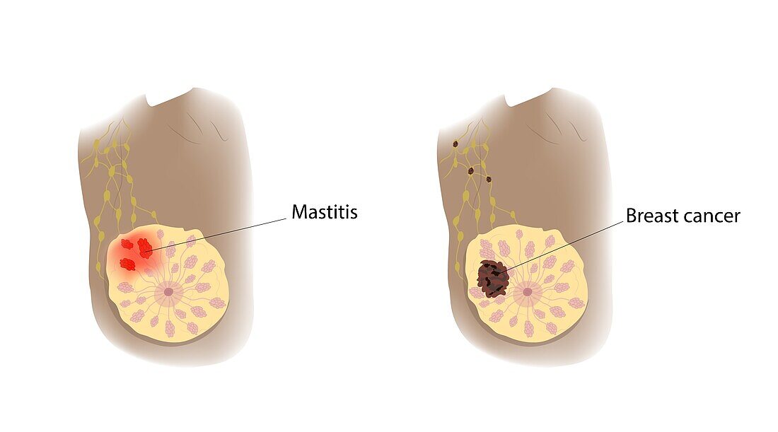 Mastitis and cancer comparison, illustration