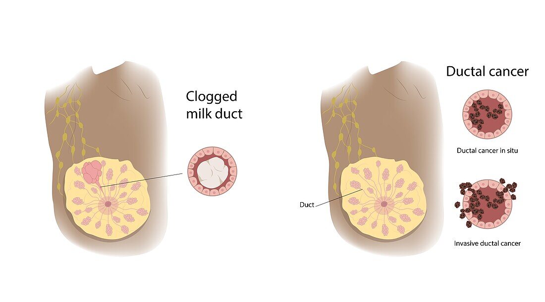 Clogged milk duct and ductal cancer comparison, illustration