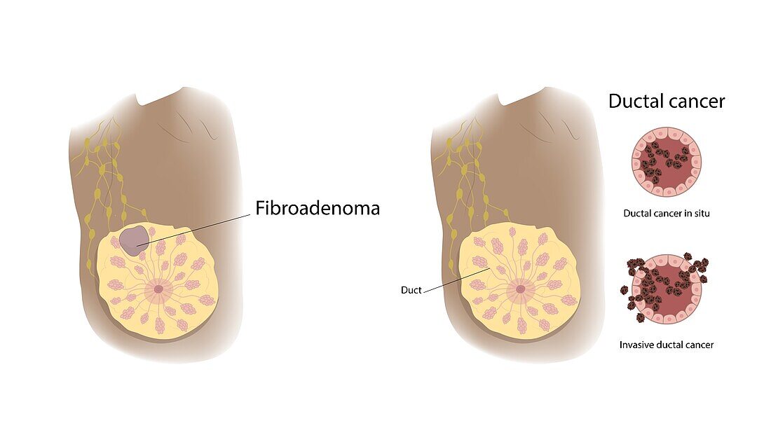 Fibroadenoma and ductal cancer comparison, illustration