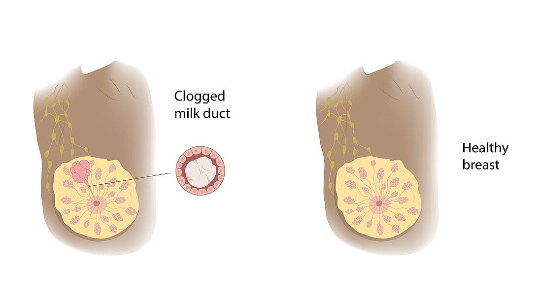 Healthy breast and clogged milk duct, illustration