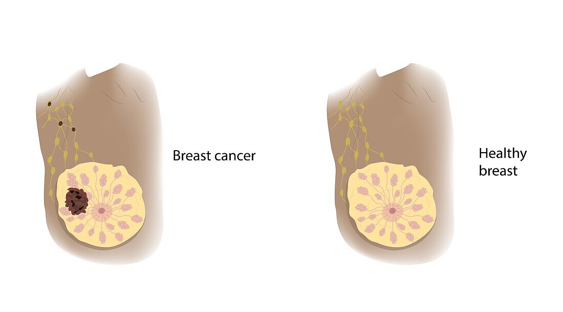 Healthy breast and cancer, illustration