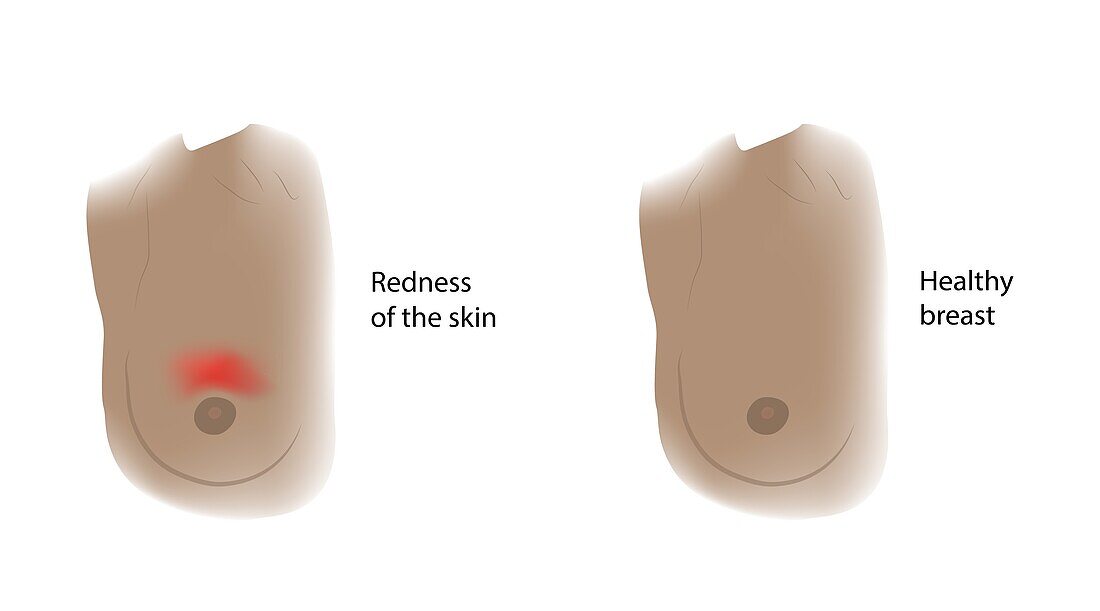 Healthy breast and redness of the skin, illustration