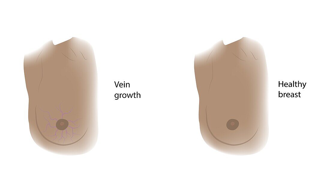 Healthy breast and vein growth, illustration