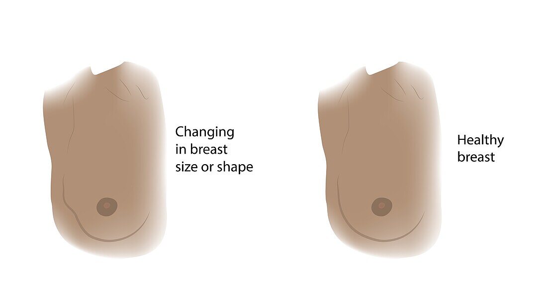 Healthy breast and changes in breast shape, illustration