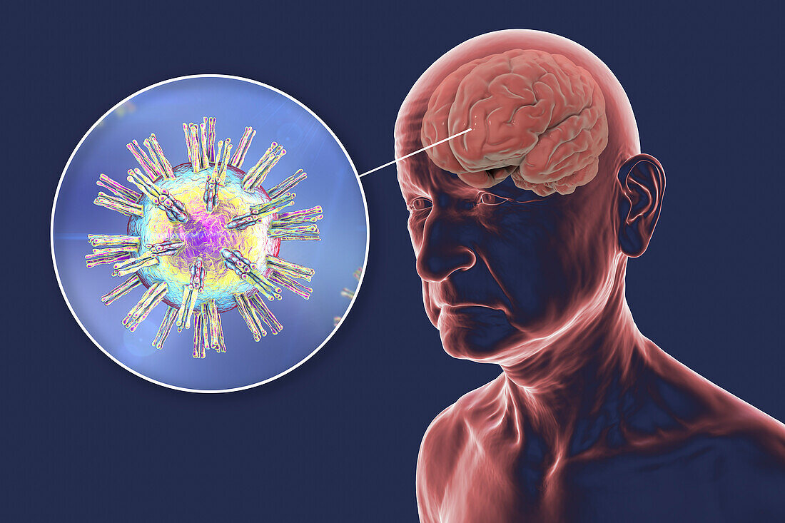 Herpes viruses and dementia, conceptual artwork