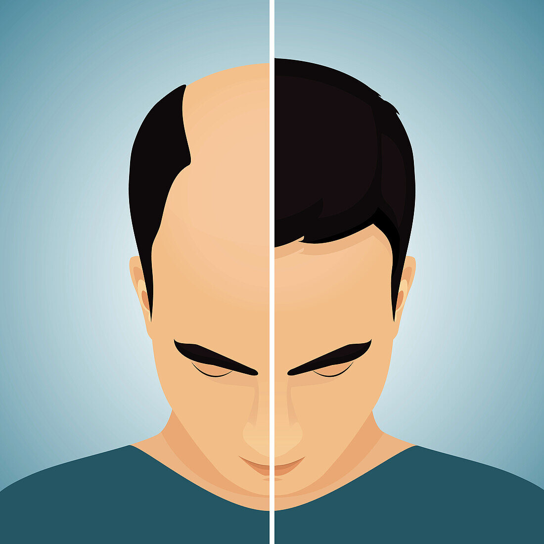 Hair loss in men, conceptual illustration