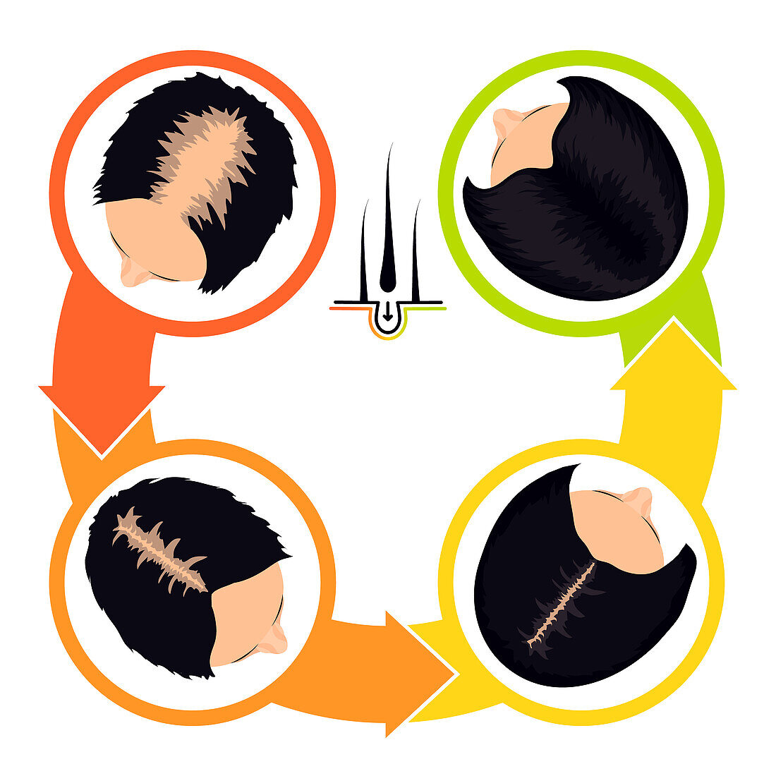 Hair transplantation in women, illustration