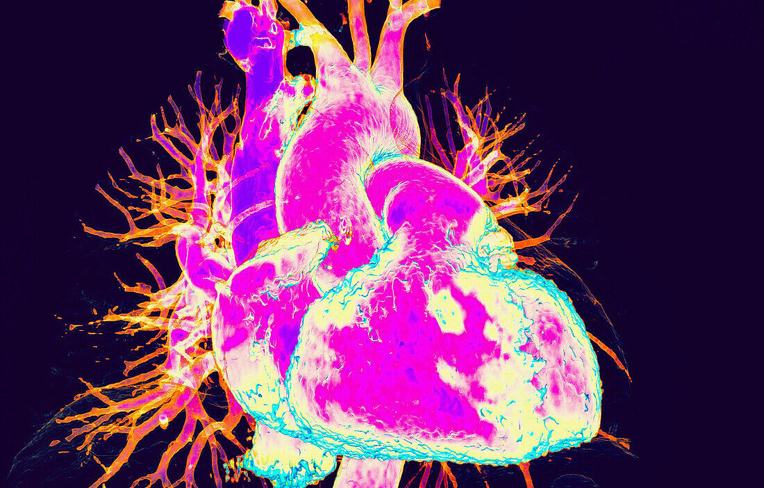 Healthy heart, 3D CT scan