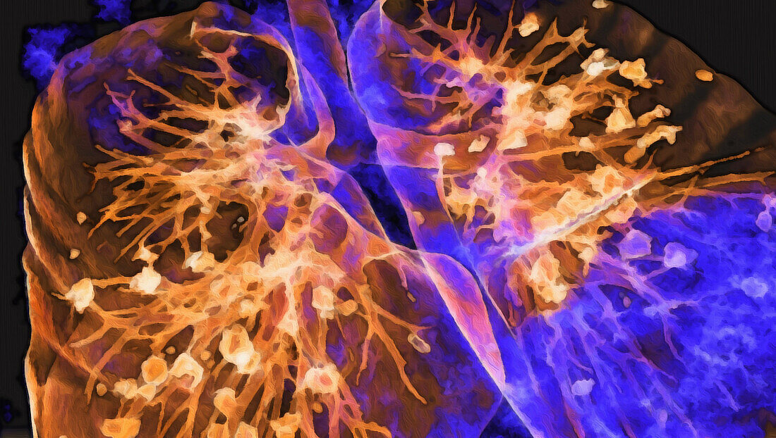 Lungs affected by Covid-19 pneumonia, 3D CT scan