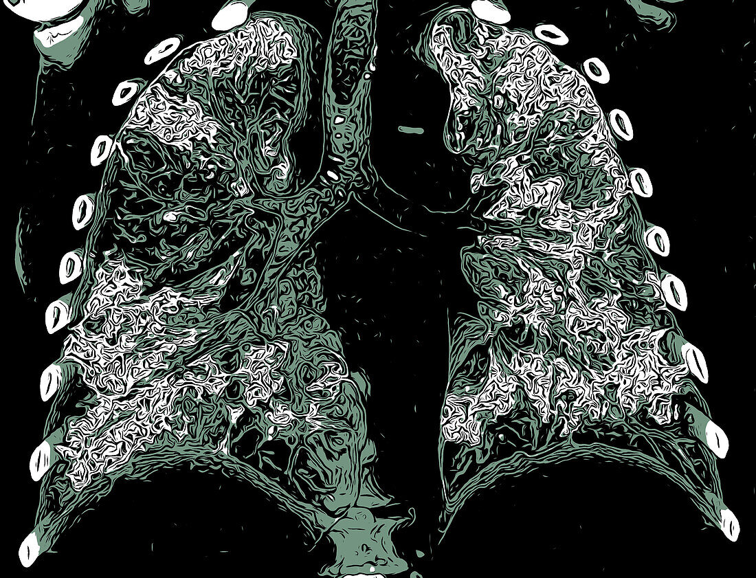 Lungs affected by Covid-19 pneumonia, 3D CT scan