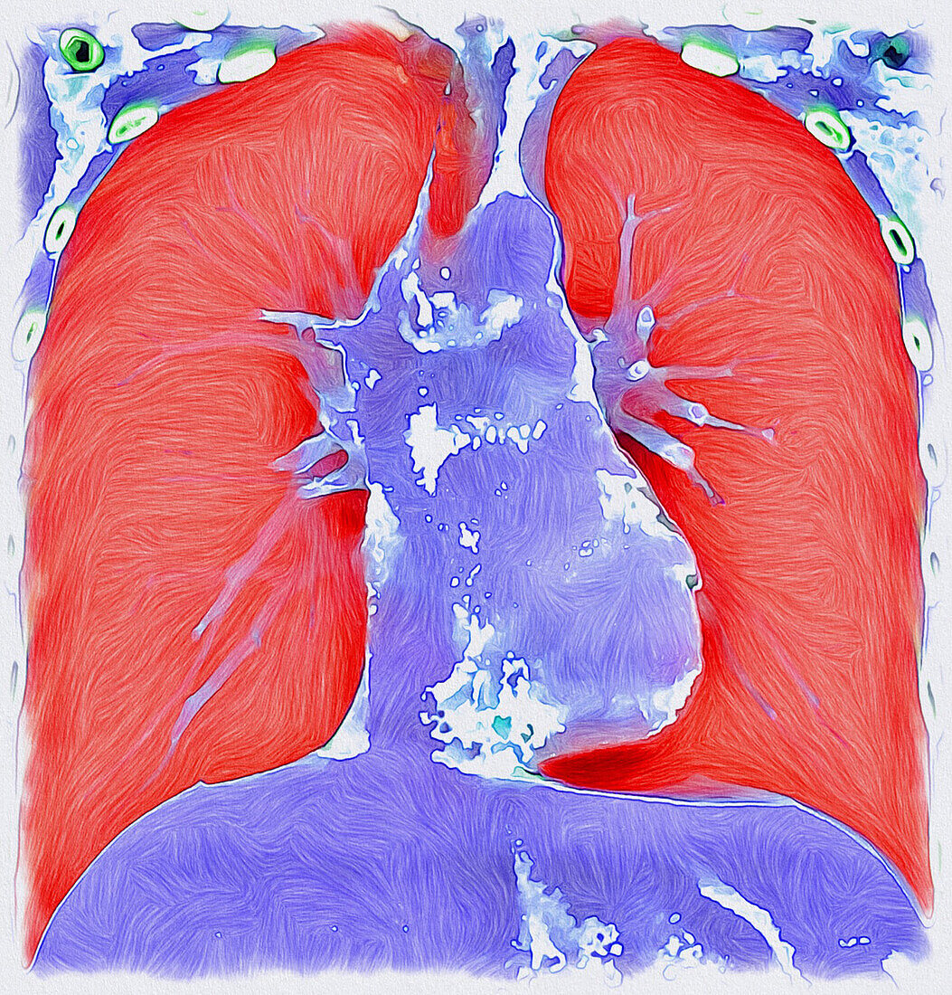 Healthy lungs and heart, CT scan