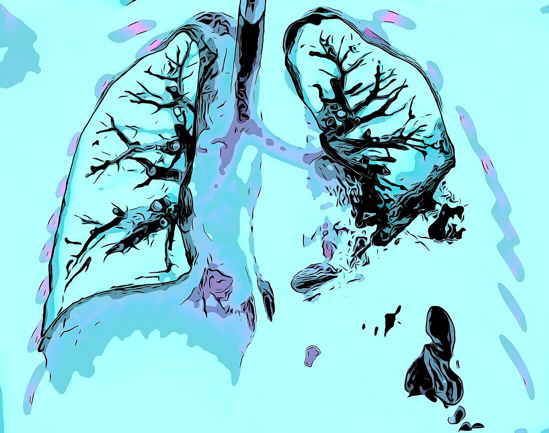 Lung affected by pneumonia, CT scan