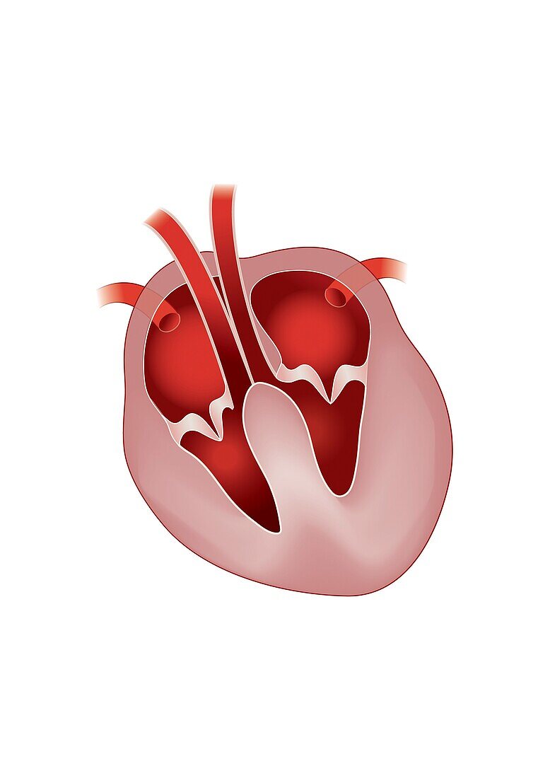 Canine hypertrophic cardiomyopathy, illustration